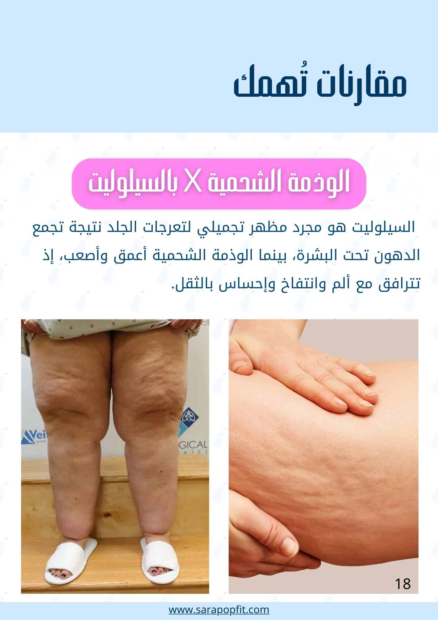 التخلص من الوذمة الشحمية - جسم الإجاصة