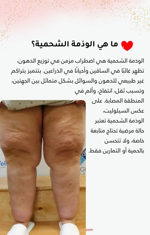 دليلك للتعرف على السيلوليت والوذمة الشحمية والتخلص منهما