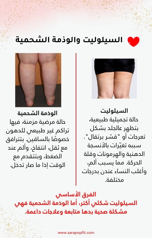 دليلك للتعرف على السيلوليت والوذمة الشحمية والتخلص منهما